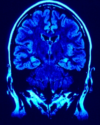 Cerebro en renonancia mágnética